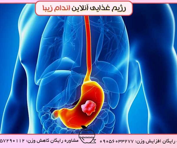 درمان زخم معده و تاثیر آن بر لاغری و چاقی