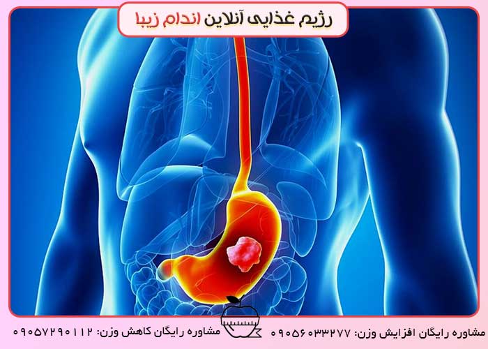 درمان زخم معده و تاثیر آن بر لاغری و چاقی