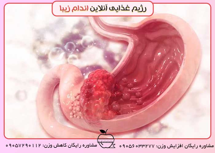 چه عواملی باعث زخم معده میشود؟